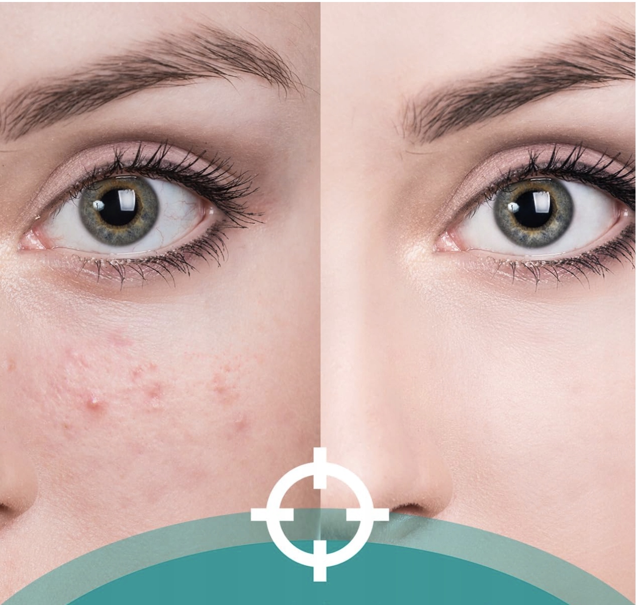 Zestaw do Usuwania Zaskórników 7Szt Wyciskanie Pryszczy Wągrów Stal - obrazek 3